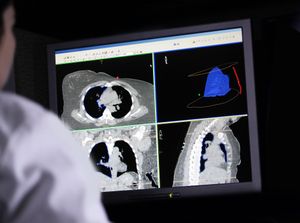 How early should I be screened for lung cancer?