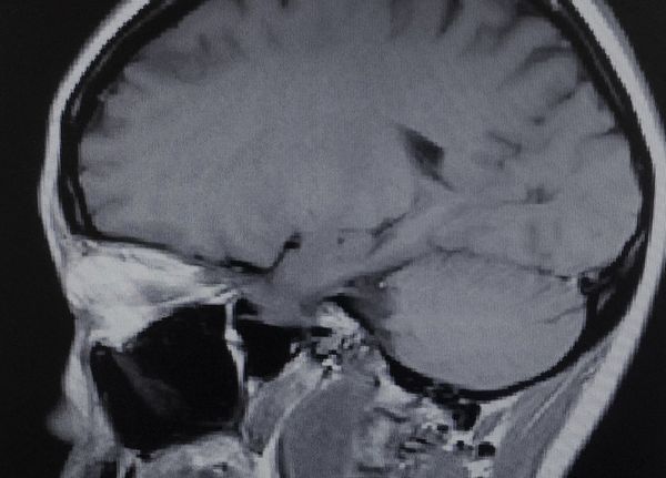 Is surgery best for an acoustic neuroma?